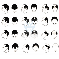 【佳學(xué)基因檢測】過早<font color='red'>脫發(fā)</font>、掉發(fā)太多怎么辦？你的方法可能是錯的！