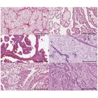 <b>【佳學(xué)基因檢測(cè)】腎臟癌靶向藥物基因檢測(cè)（Kidney Cancer)</b>